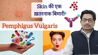 Pemphigus  skin की एक ख़तरनाक बिमारी  चमड़ी और मुँह में छाले और घाव pemphigus oralulcer ulcers [upl. by Cutlip]