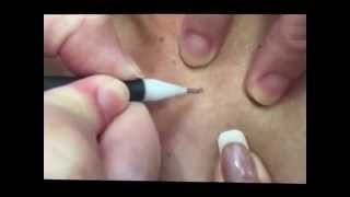 Clinical Skin Clear  Removing raised fibroma [upl. by Ellahcim]