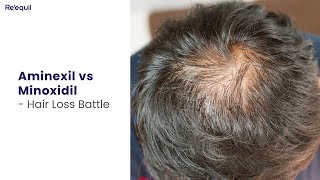 Aminexil vs Minoxidil  Hairloss Battle [upl. by Neerom601]