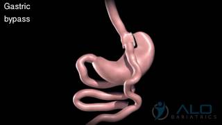 Gastric Bypass Process Explanation  Animation Video  ALO Bariatrics [upl. by Odoric]