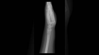 Buckle fracture at the distal radius metaphysis xray [upl. by Wolfy276]