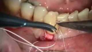 periodontal microsurgery Functional Grafting with AlloDerm [upl. by Lira]