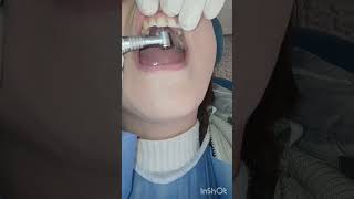 طبييب الاسنان ي dentist stitch اكسبلور عالج جذور الاسنان [upl. by Hanikehs]