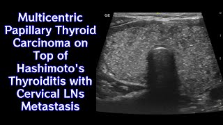 Multicentric Papillary Thyroid Carcinoma on Top of Hashimotos Thyroiditis with Cervical LNs Mets [upl. by Hanna861]