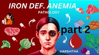 iron deficiency anemia  part 2 [upl. by Silisav373]