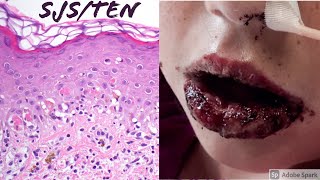 StevensJohnson SyndromeToxic Epidermal Necrolysis SJSTEN Spectrum [upl. by Jerman]