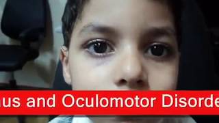 Intermittent Exotropia  الحول الوحشي المتقطع [upl. by Delahk998]