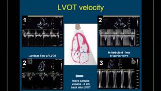 Guidelinebased Webinar on the Echo Assessment of Aortic Valve Stenosis [upl. by Airdnua]