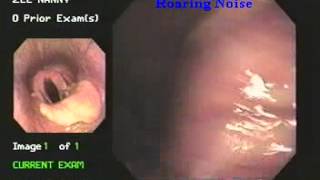 roaring disease laryngeal hemiplegiaby endoscopy [upl. by Adnohsak]