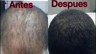 Minoxidil para Crecer Barba y Pelo [upl. by Schwenk]