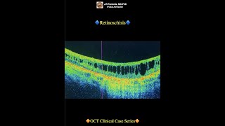 Retinoschisis [upl. by Tenom29]