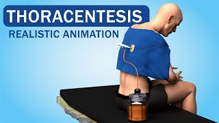 Pleural Tap Explained Lung Fluid Drainage for Relief Thoracentesis [upl. by Yasnil99]