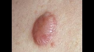 How to Get Rid of a Stubborn Keloid [upl. by Darra]