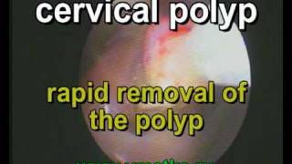 Rapid removal of the cervical polyp [upl. by Kilbride]