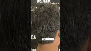 Alopecia Areata Treatment with ILS at Skinaa Clinic viral shorts [upl. by Notsniw]