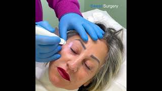 Nonsurgical Blepharoplasty fibroblasting blepharoplastic plasmalifting plasmapen [upl. by Idnak738]