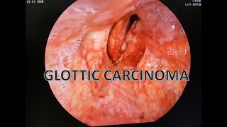 LARYNGEAL CARCINOMA GLOTTIC CARCINOMA [upl. by Oemac]