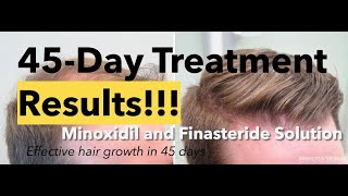 Minoxidil and Finasteride 5 Topical Solution results after 45 days and shedding phase [upl. by Assed]