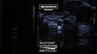 Learn Thyroid Ultrasound ultrasoundeducation familymedicine [upl. by Birdt481]