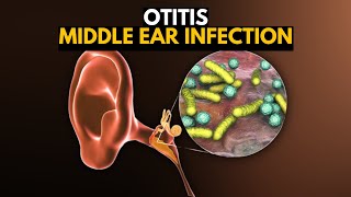 Middle Ear Infection Otitis Media Causes SIgns and Symptoms Diagnosis and Treatment [upl. by Denae]