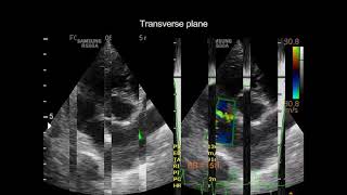 Pulmonic stenosis in a dog [upl. by Adnahsor]