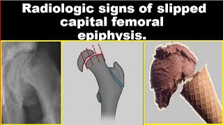 Radiologic signs of Slipped Capital Femoral Epiphysis [upl. by Obola700]