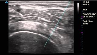 Right Shoulder Subacromial Bursitis diagnosed by Ultrasound with injection [upl. by Yarehs205]