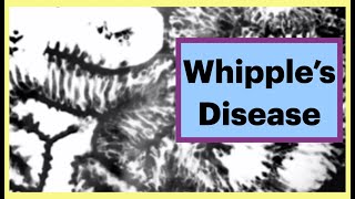 Whipple Disease gastroenterology radiology learnwithme [upl. by Tila25]