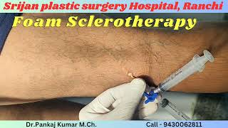 Varicose veins treatment with foam Sclerotherapy Varicose veins treatment for SSC GD medical test [upl. by Frierson]