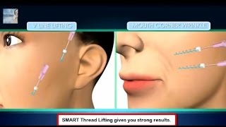 Smart Spiral Thread Lift NonSurgical Face Lift [upl. by Cooper]