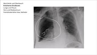 Röntgen Thorax Befundung [upl. by Sairacaz]