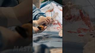 How Angioplasty Can be Done  Watch by 3d Animation shorts biology angioplasty surgeon 3dheart [upl. by Gratianna256]