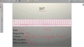 ECG Atrial Rhythms AF AFRVR SVT PAC [upl. by Romilda118]