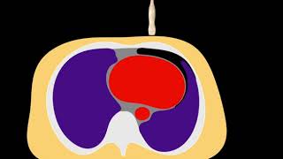 POCUS  Lung Ultrasound How to diagnose a pneumothorax with ultrasound [upl. by Nnoryt759]