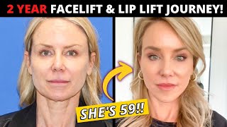 59 Year Olds 2 Year Facelift and Lip Lift Journey her entire postop recovery [upl. by Yrek92]