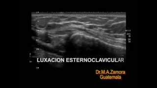 Luxación esternoclavicular [upl. by Dorcea70]