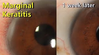 Marginal keratitis [upl. by Roye976]