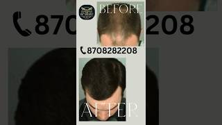 Hair Treatment Before amp After  Dr Grewal  8708282208 shorts viralvideo [upl. by Kurr]