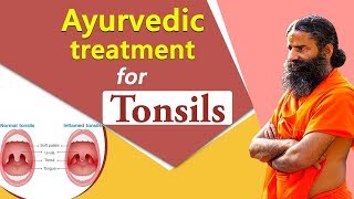 Ayurvedic Treatment for Tonsil  Swami Ramdev [upl. by Schoenburg]