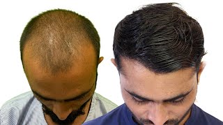 5500 Hair Grafts Before amp After  New Roots Hair Transplant Nagpur [upl. by Alphonso510]