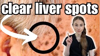 Get Rid Of Liver Spots FAST  Seborrheic Keratosis [upl. by Niu242]