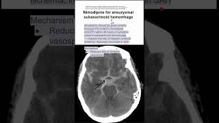 Nimodipine for aneurysmal subarachnoid hemorrhage [upl. by Huff]