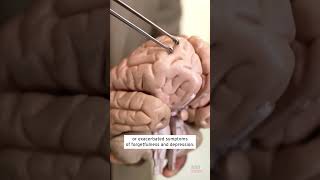 Live Parasitic Worm Removed From Woman’s Brain shorts [upl. by Phillis]