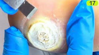 17This plantar wart is round and large [upl. by Aicram314]