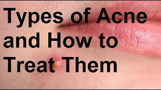 Types of Acne and How to Treat Them [upl. by Skeie]