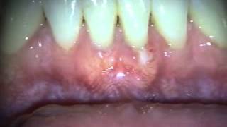 Periodontal Microsurgery AlloDerm Grafting Lower Anterior [upl. by Annyahs]