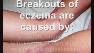 Eczema Dermatitis [upl. by Wiseman360]