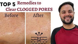 Top 5 Remedies to Clear Clogged Pores amp Blackheads [upl. by Euphemiah914]