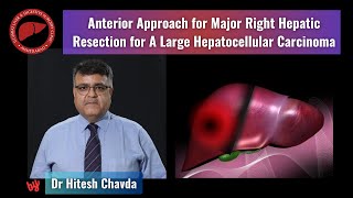 The anterior approach for right hepatectomy for a large hepatocellular carcinoma  Dr Hitesh Chavda [upl. by Jill]