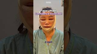 See My Dramatic Facelift Transformation [upl. by Nameerf]